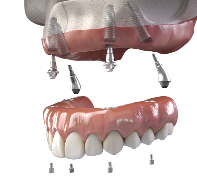 10x Your Practice With Full Arch Implants